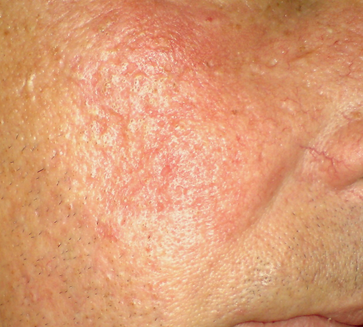 Acne rosacea,розовые угри
