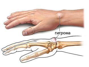 гигрома